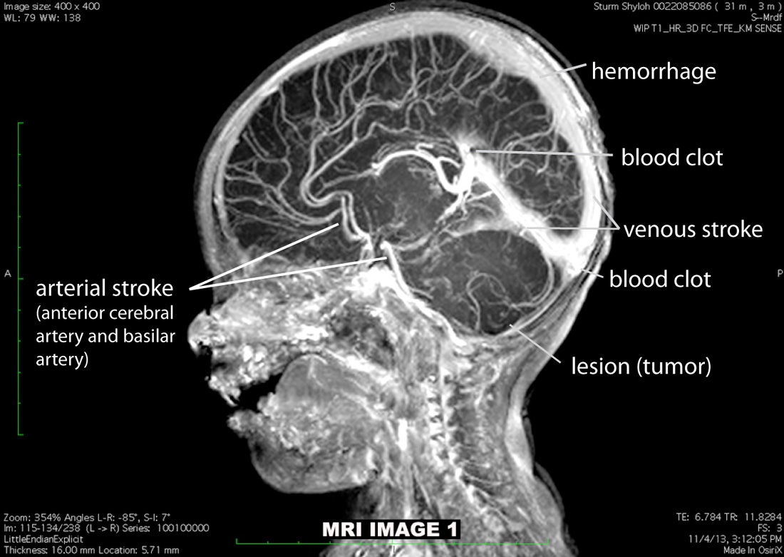 Shyloh's MRI at 3 months old, T1 post gadolinium, sagittal mideline brain with cancer (likely PNET), arterial and venous strokes and hemorrhage